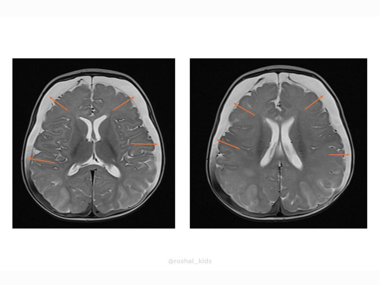У младенца нашли редкий синдром из трех букв - МК